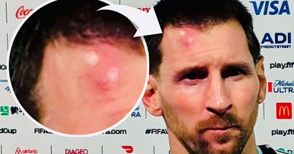 Messi sưng vêu trán sau trận thắng Cabo Verde: Vì sao nên nỗi? - hình ảnh - nohu90bet.vip Messi sưng vêu trán sau trận thắng Cabo Verde: Vì sao nên nỗi? - hình ảnh - nohu90bet.vip